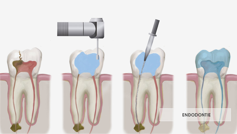 endodontie