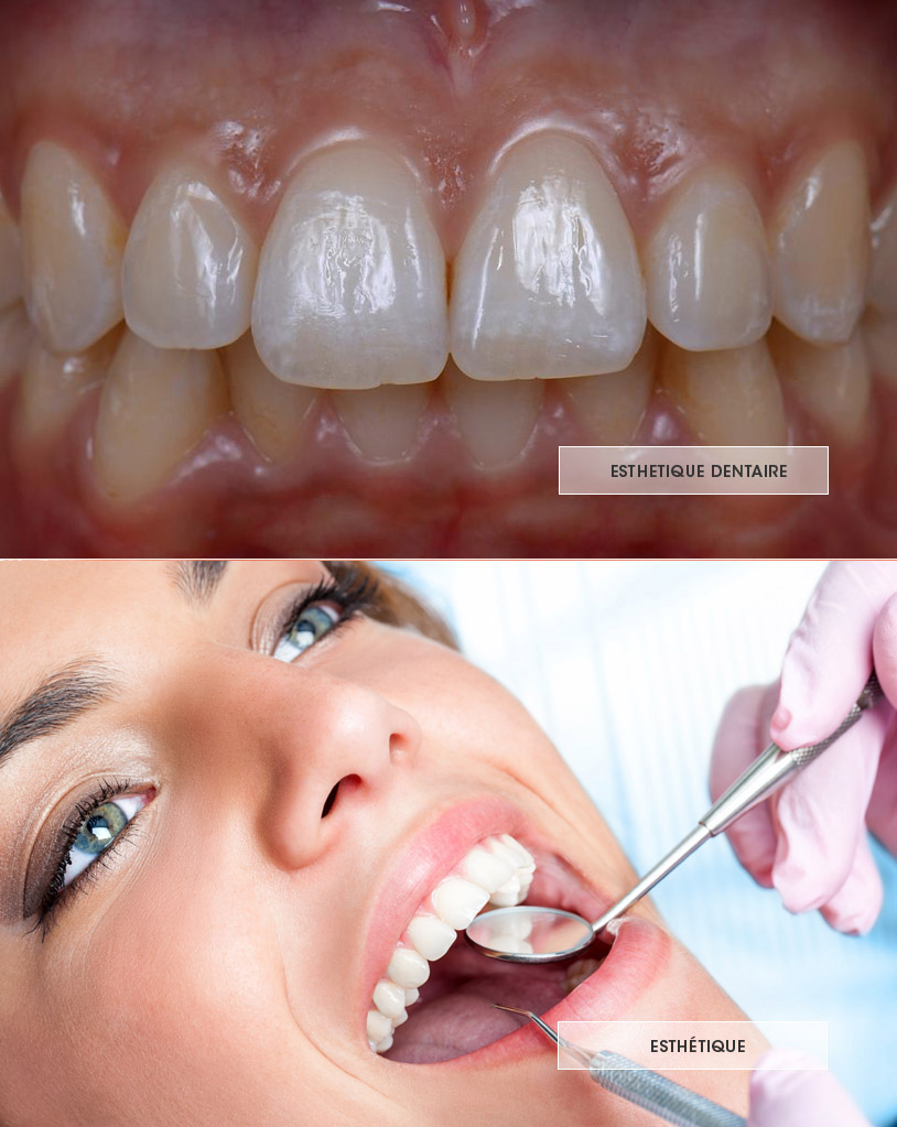 esthétique dentaire, implants dentaires