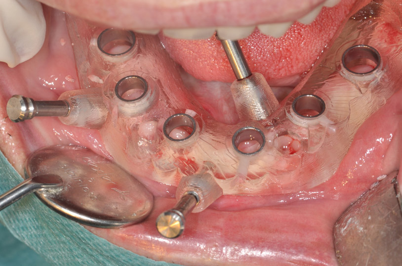 chirurgie implantaire sans lambeau