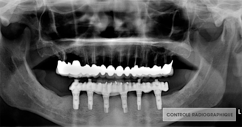 prothèse, contrôle radiographique, équilibration occlusale