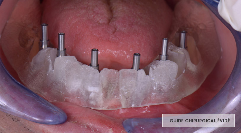 transferts d'empreinte, axe des implants dentaires