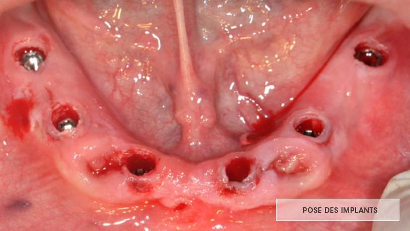 pose des implants dentaires