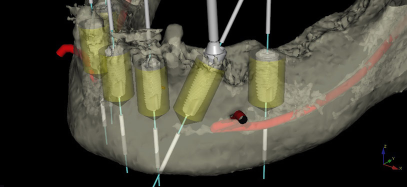 NobelClinician. Vue en 3D de la prothèse mandibulaire et des implants dentaires