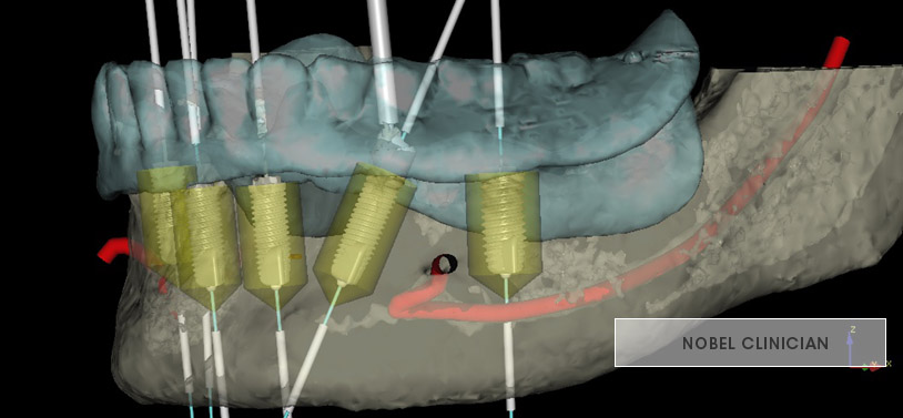 planification de la chirurgie implantaire