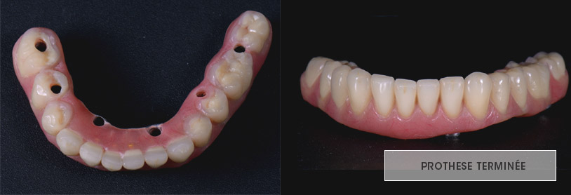 Extrados et intrados de la prothèse terminée