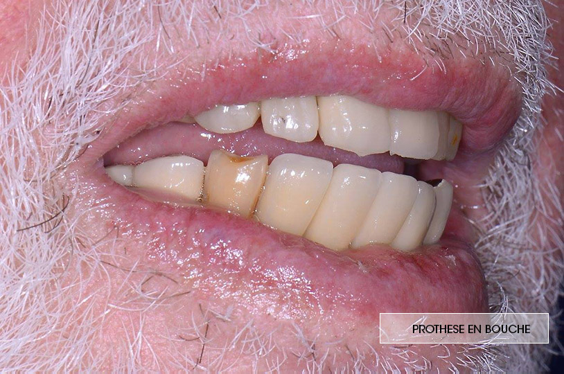prothèse en bouche