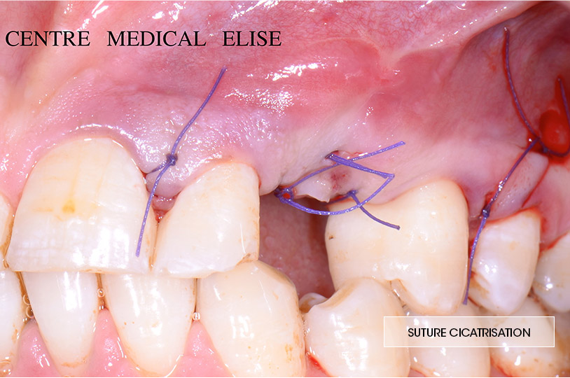 suture cicatrisation