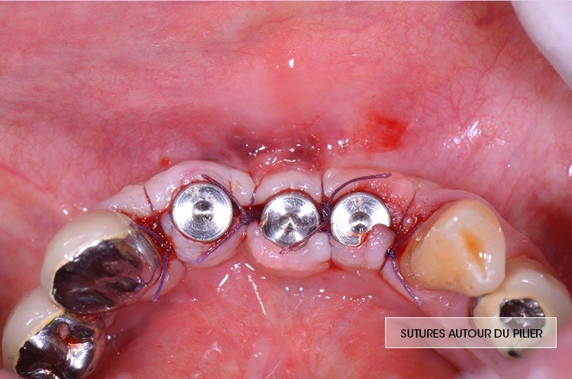 sutures autour des piliers implantaires